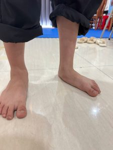 Các Phương Pháp Điều Trị Bàn Chân Bẹt Hiệu Quả