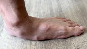 bàn chân bẹt người lớn có chữa được không