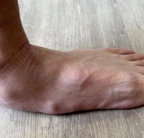 bàn chân bẹt người lớn có chữa được không