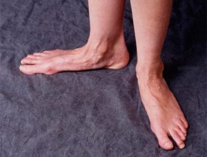 Bàn chân bẹt người lớn